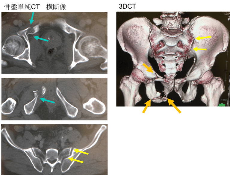最上_敦彦骨盤骨折 = Fractures of the pelvis and acet 